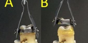 FIRST-EVER REVERSIBLE CEMENT - amdlasers